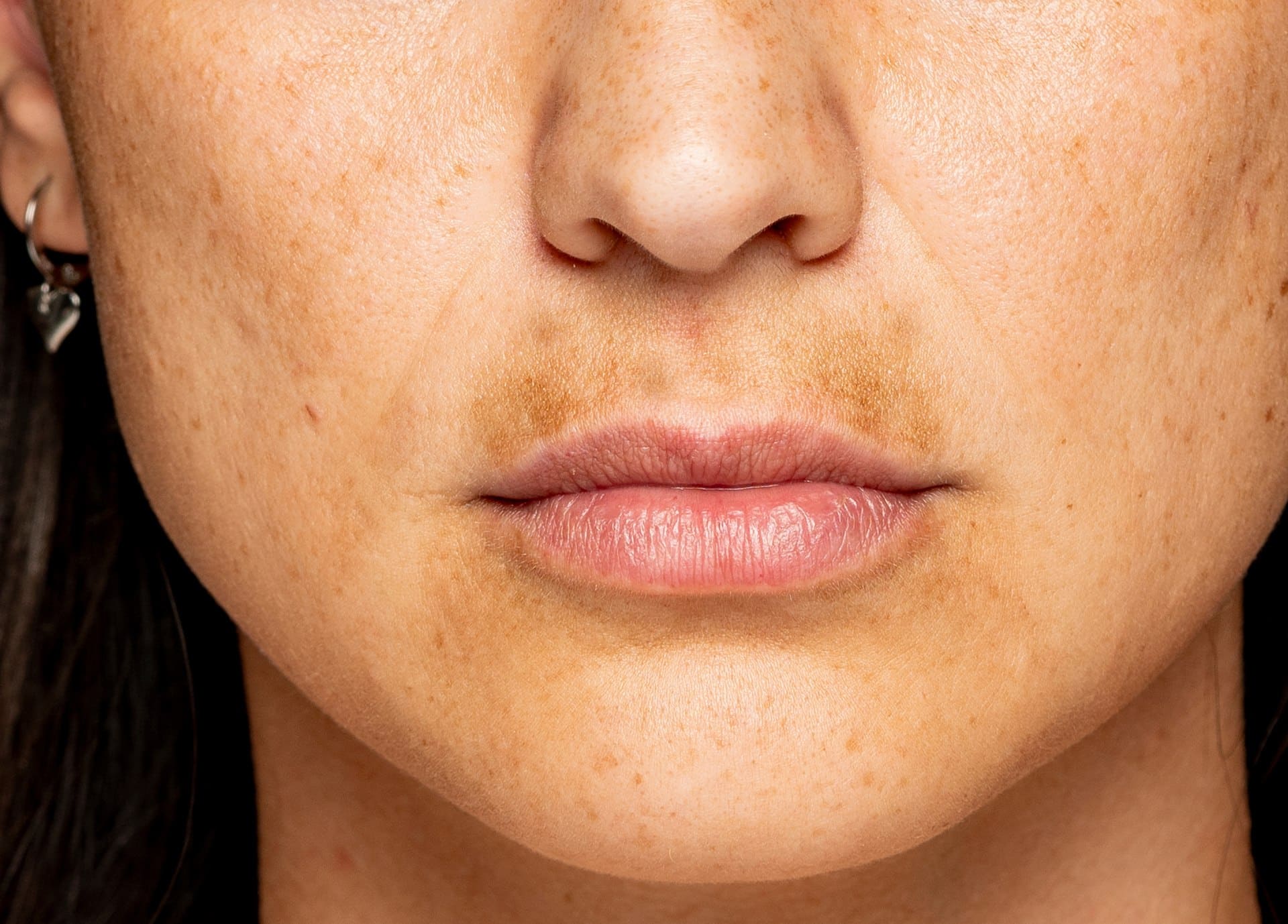 J'ai des taches brunes : causes et traitements taches pigmentaires | Dr Taveau | Paris